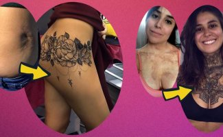 До и после: невероятные преображения людей с сильными рубцами после ожогов и шрамами (21 фото)