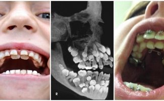 Пугающие факты о человеческом теле: как возникает аномалия зубов (8 фото)